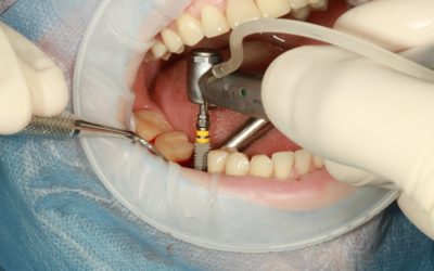 ¿Como Se Colocan Los Implantes Dentales?