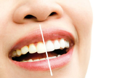 ¿Cómo evitar los dientes amarillos?